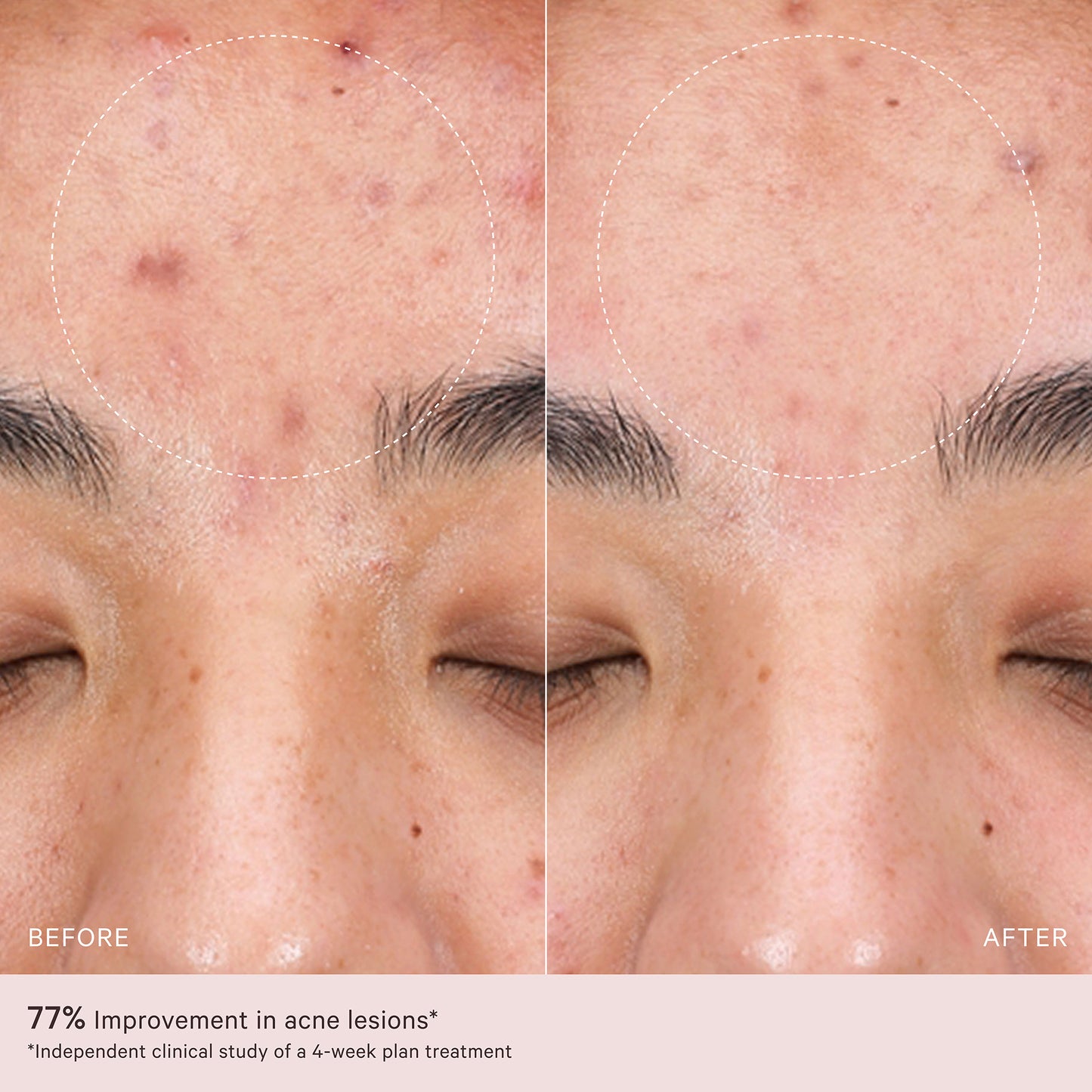 Lightmax Supercharged Led Mask 2.0