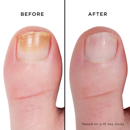 Nail Brightening Treatment