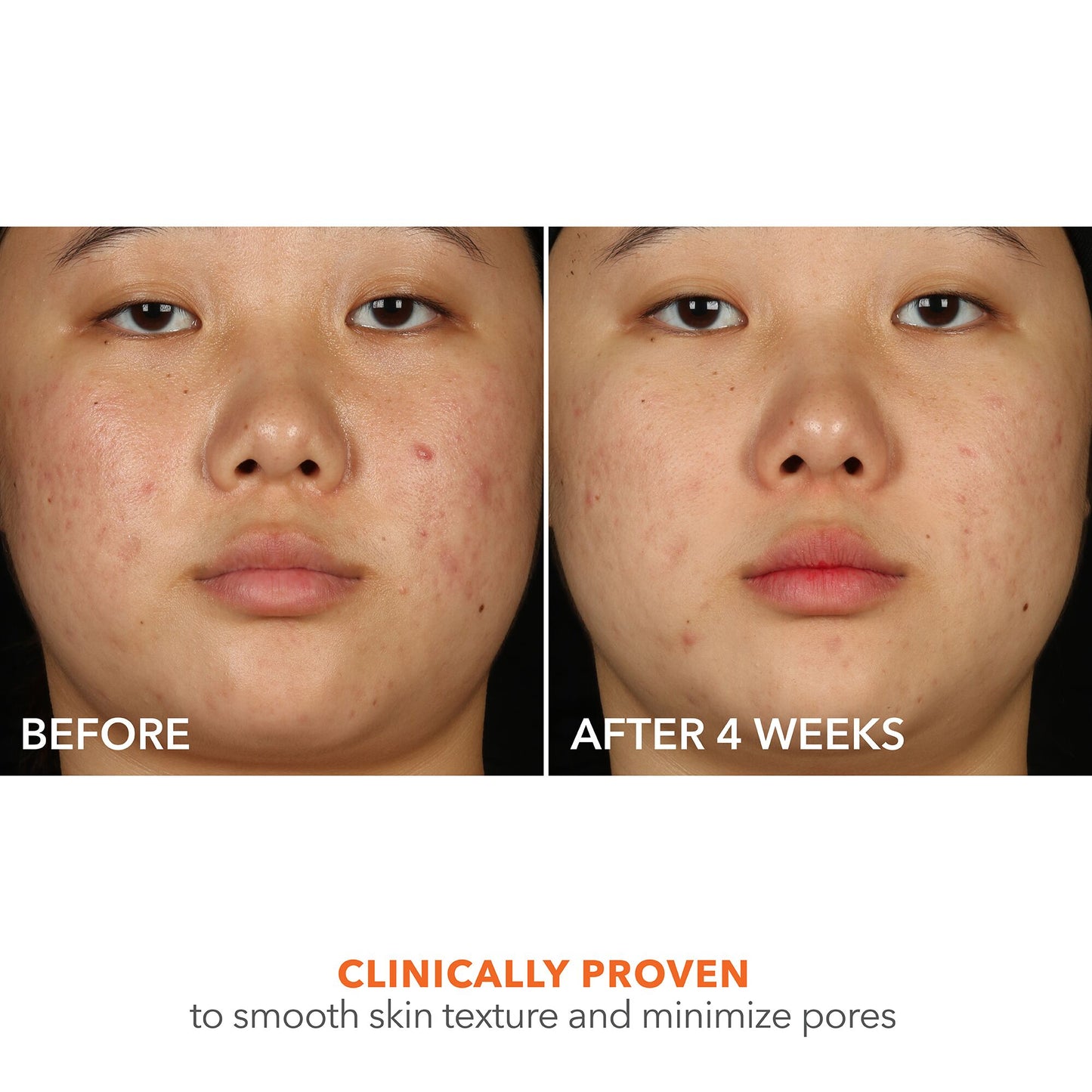 Alpha Beta 2% BHA+ Breakout Solution