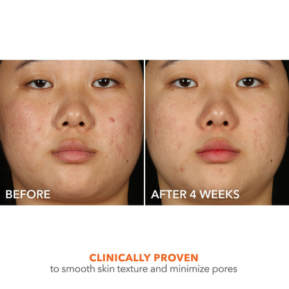 Alpha Beta 2% BHA+ Breakout Solution