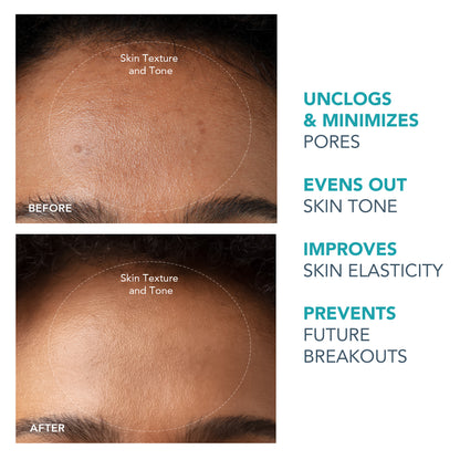 Kiwi Blackhead Remover Pore Vacuum