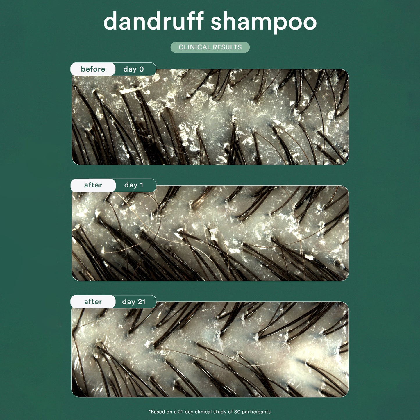 Dandruff Shampoo