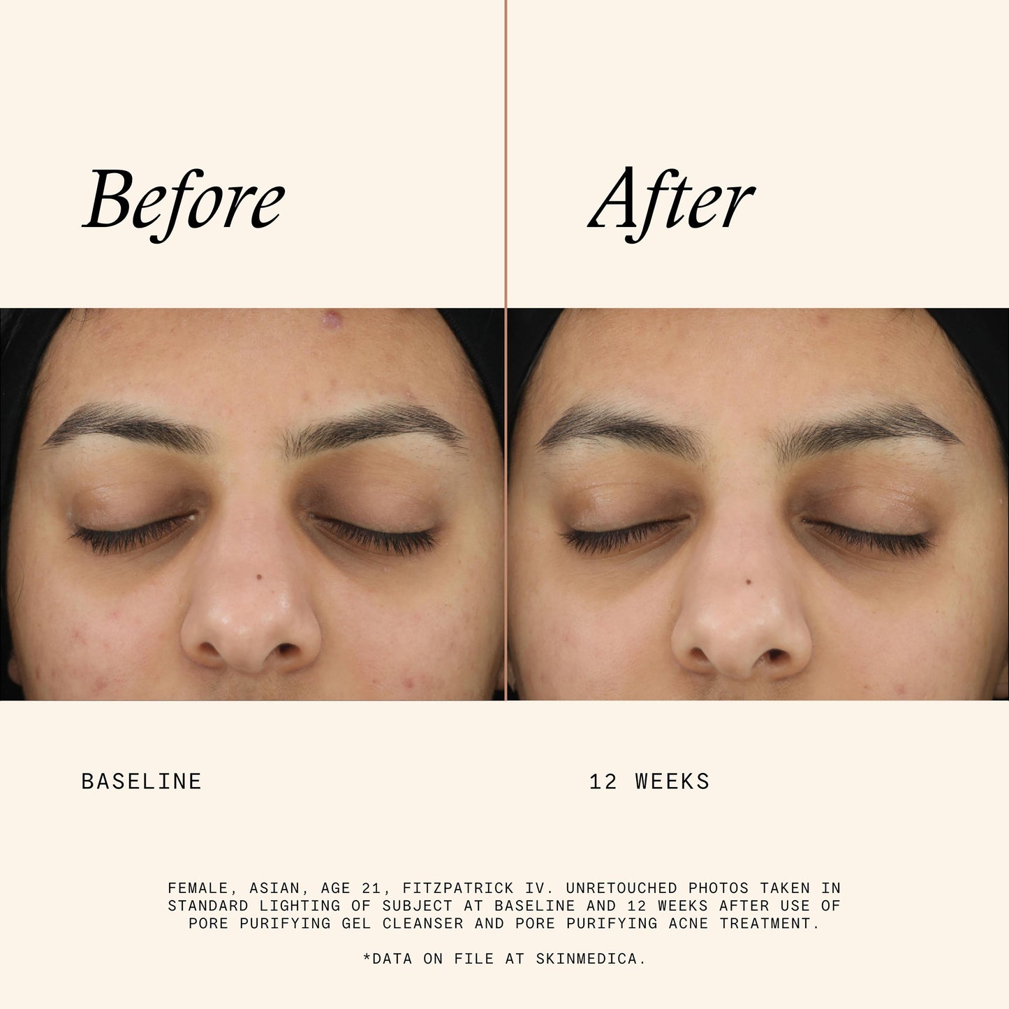 Acne Clarifying Treatment