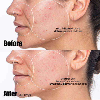 Peacekeeper Azaleic and Salicylic Acid Acne Treatment Serum