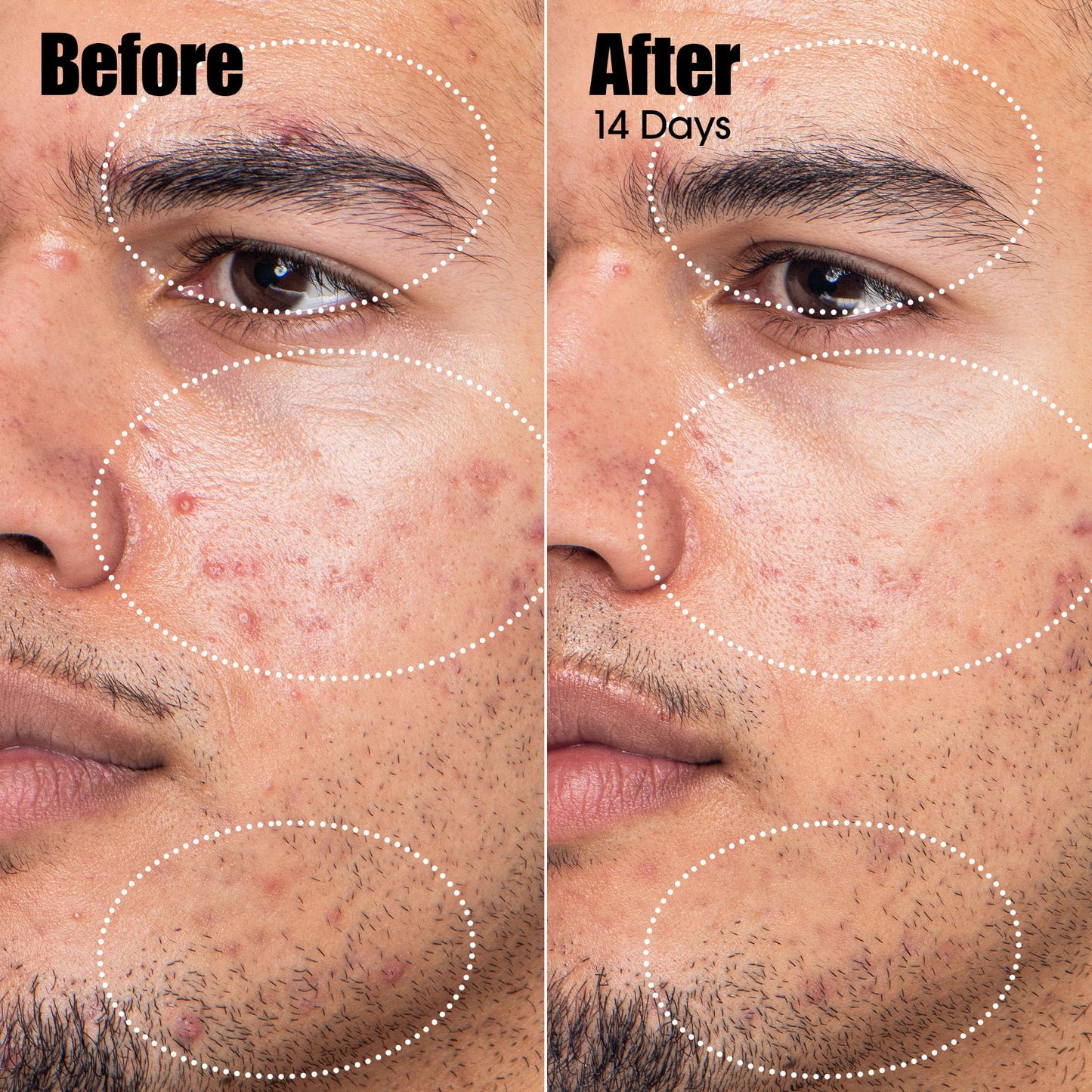 Peacekeeper Azaleic and Salicylic Acid Acne Treatment Serum