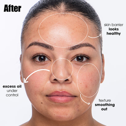 Breakout Breakup Salicylic Acid Cleanser for Blemish-Prone Skin