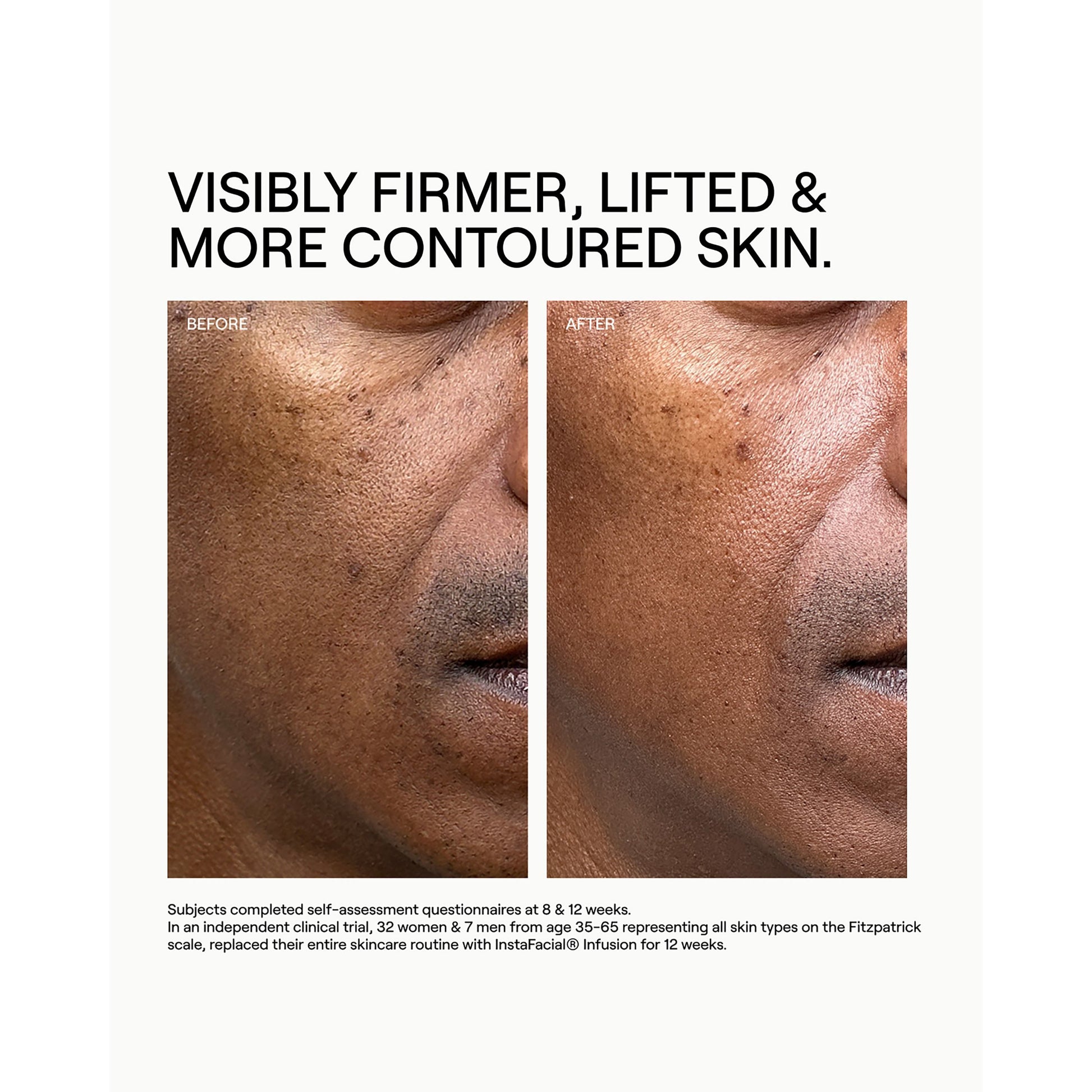Instafacial Infusion Biomimetic Microcollagen Matrix