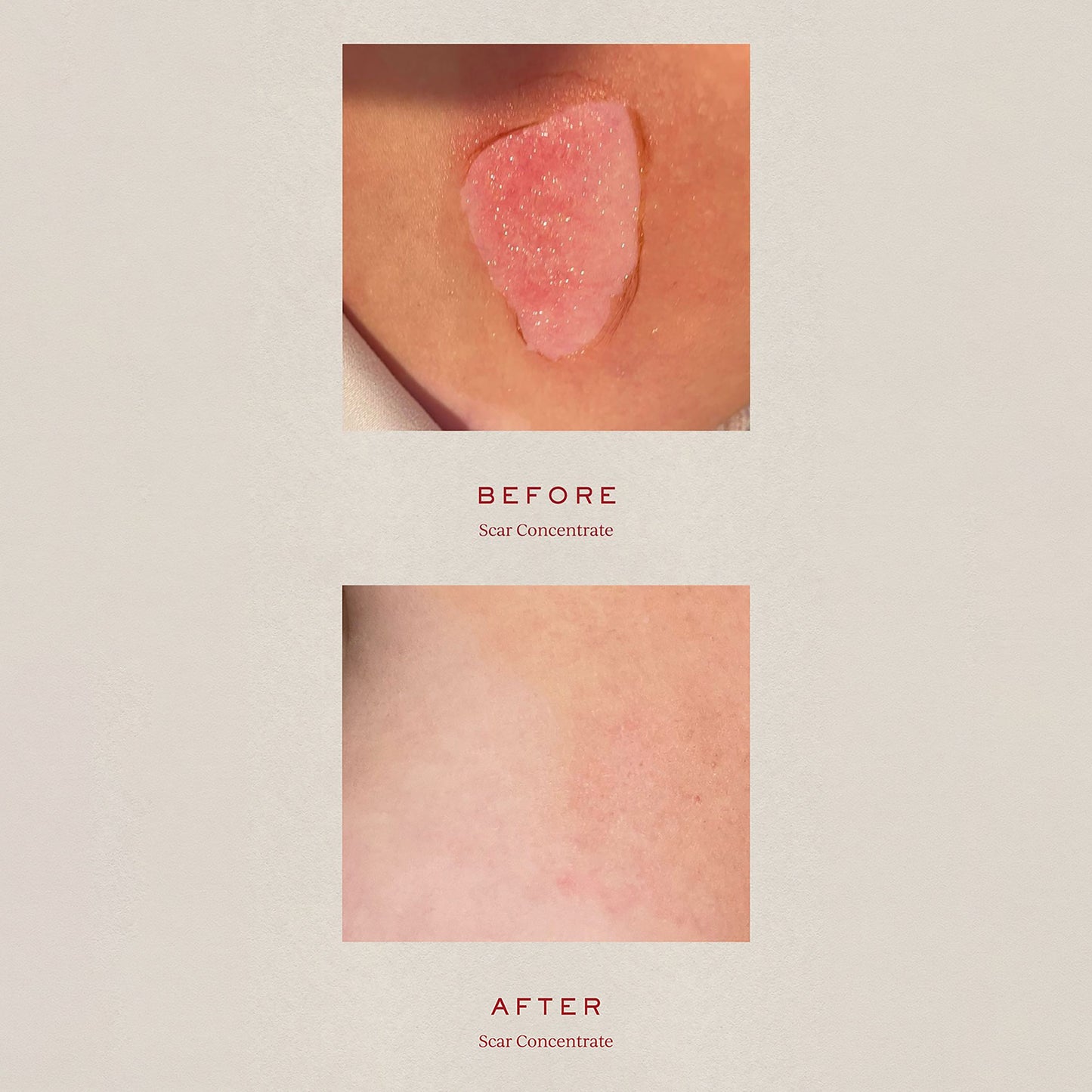 Scar Concentrate